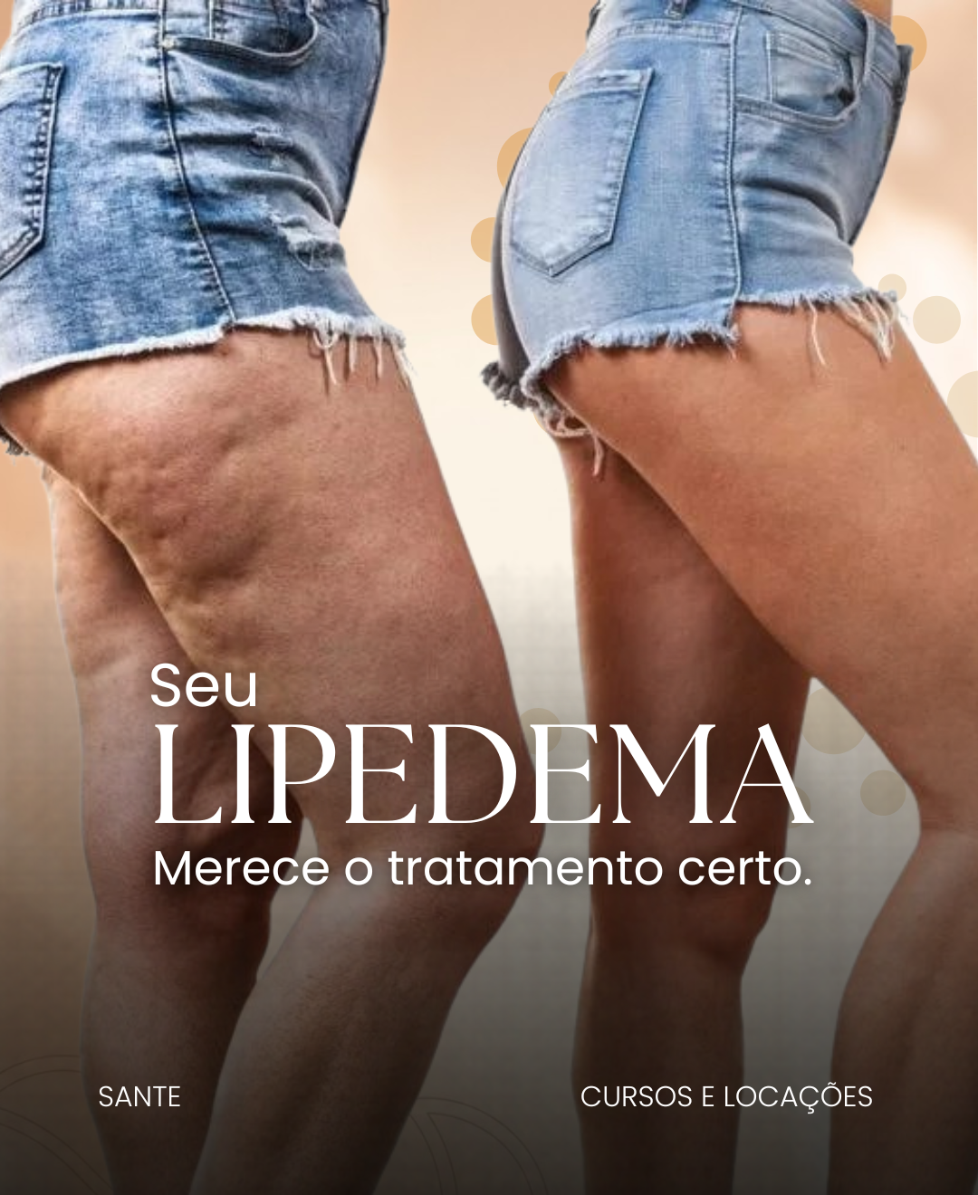 Lipedema